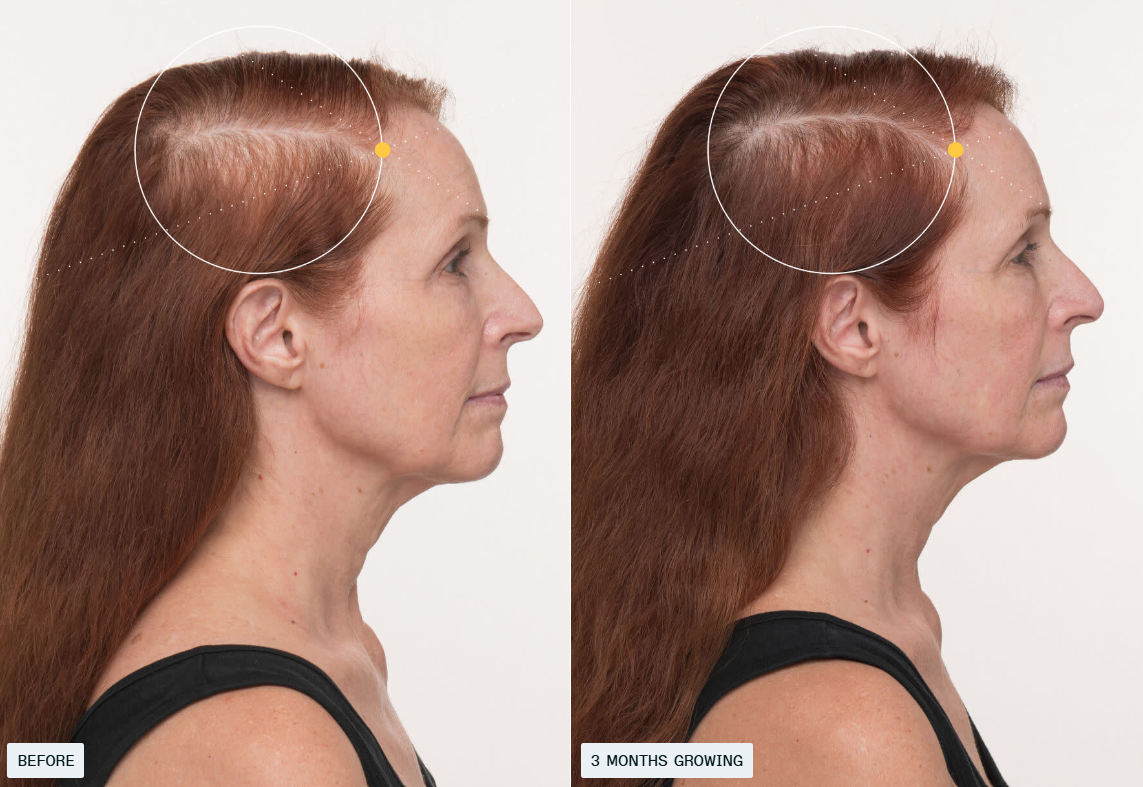 Nutrafol Hair Growth Supplements – Clinically Proven for Thicker, Stronger Hair Men&Women