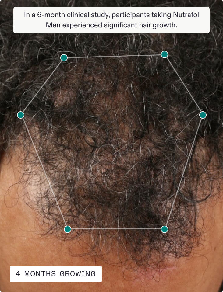 Nutrafol Hair Growth Supplements – Clinically Proven for Thicker, Stronger Hair Men&Women