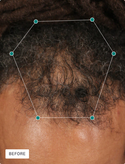 Nutrafol Hair Growth Supplements – Clinically Proven for Thicker, Stronger Hair Men&Women